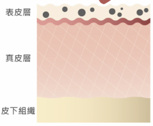 淺層雀斑分層圖