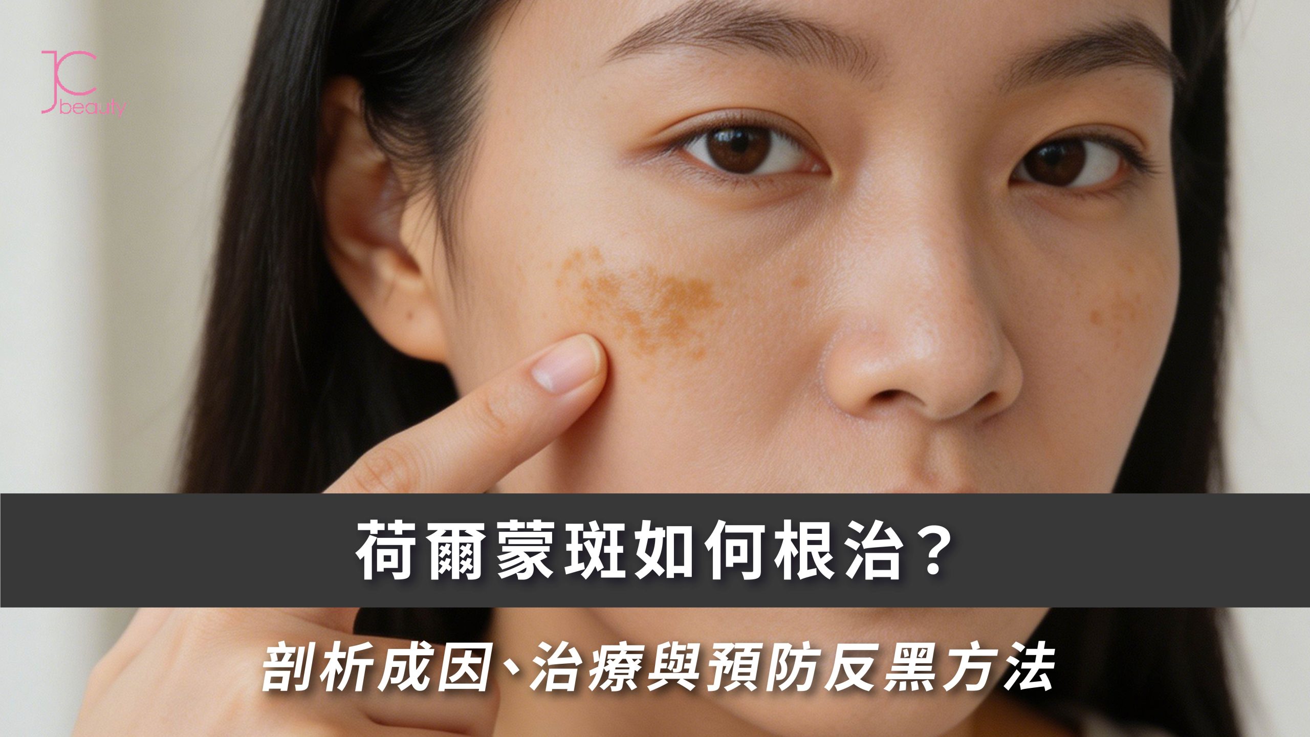 荷爾蒙斑如何根治？剖析成因、治療與預防反黑方法