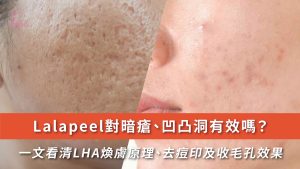 Lalapeel效果解密 | LHA煥膚改善暗瘡、凹凸洞及收細毛孔