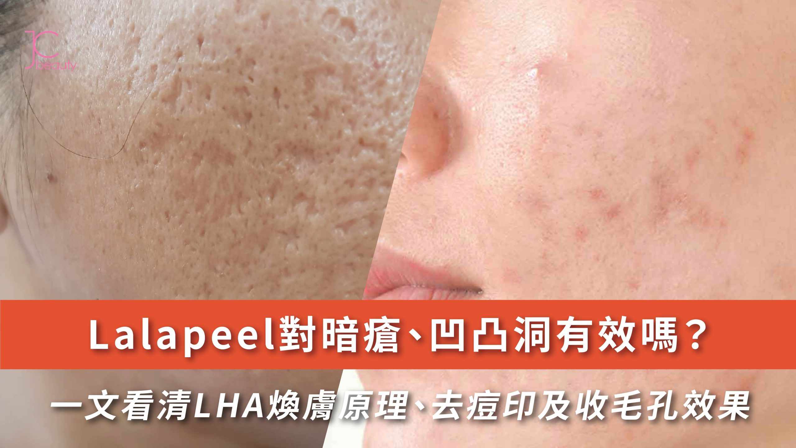 Lalapeel效果解密 | LHA煥膚改善暗瘡、凹凸洞及收細毛孔