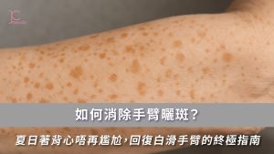 手臂曬斑如何消除？從成因到激光療程 | 助你夏日自信著背心